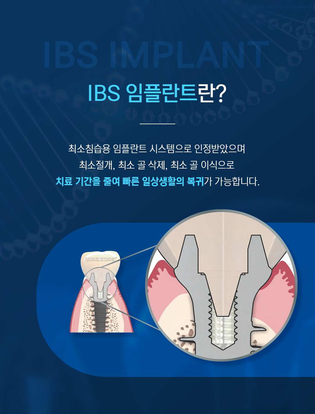 IBS 임플란트